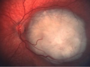Retinoblastoma. Especto del fondo de ojo. (cortesía del Dr. Fernando Arévalo)